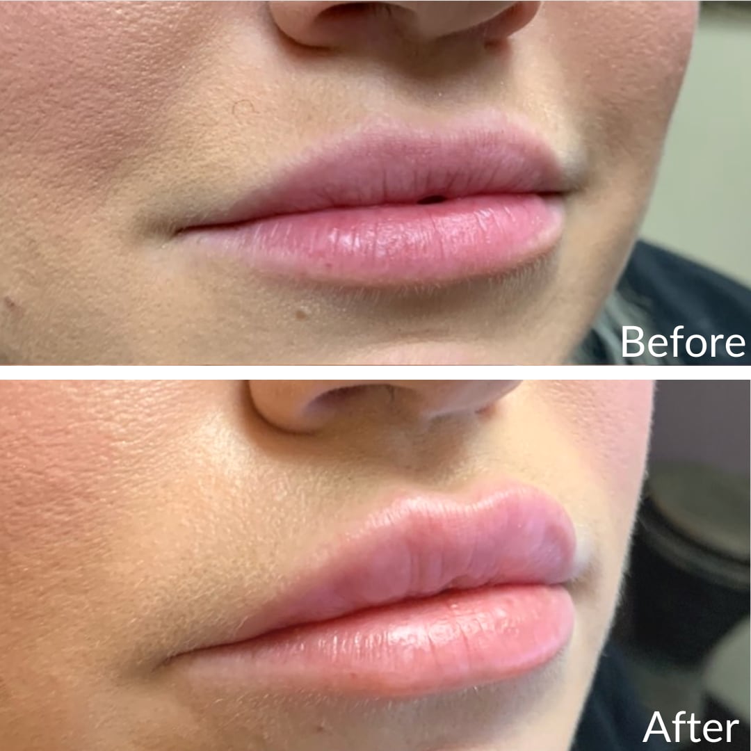 Before and after lip filler: a patient's lips, thin before and fuller after, right front oblique view