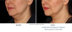 CoolSculpting manufacturer chart: a patient's chin and neck before and eight weeks after treatment