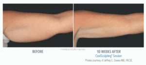 CoolSculpting manufacturer chart: a patient's upper arm before and ten weeks after one session