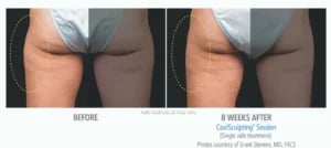 CoolSculpting manufacturer chart: a patient's outer thighs before and eight weeks after one session
