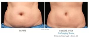 CoolSculpting manufacturer chart: a patient's abdomen before and eight weeks after one session