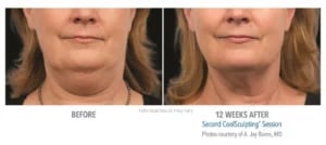 CoolSculpting manufacturer chart: a patient's chin and neck before and twelve weeks after the second session