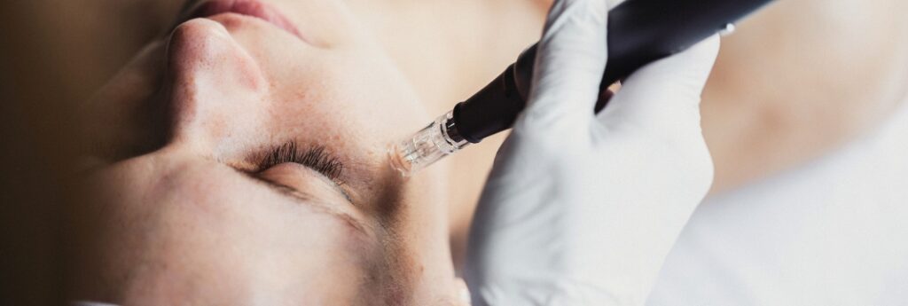 Photograph of a model: a microneedling pen at a patient's cheek, eyes closed