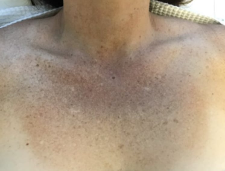 Before AFT treatment: a woman’s chest with uneven, sun-marked skin