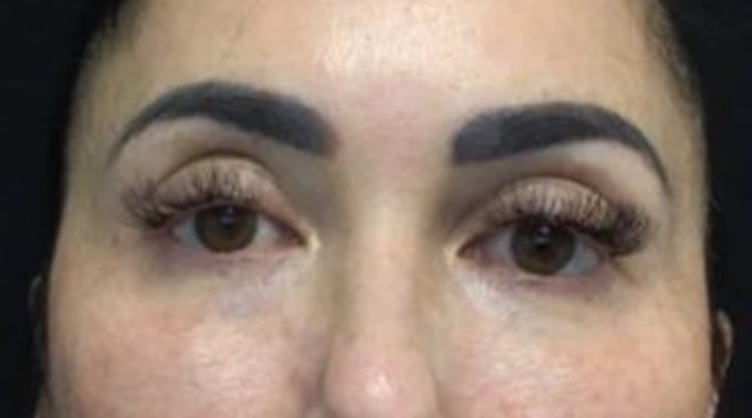 After PRP under the eyes: the same view four months later, the area under the eyes looks brighter