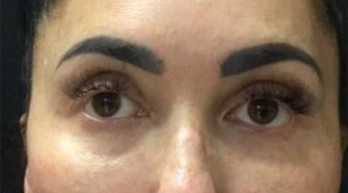 Before PRP under the eyes: front view of a woman’s eyes with dark brows and lashes, a shadow under each eye