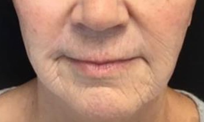 After Pixel laser treatment: the same view after treatment, the skin around the mouth and chin looks smoother