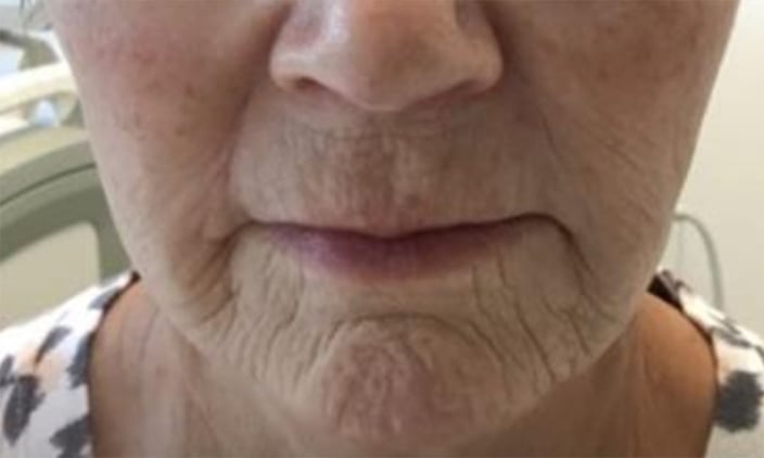 Before Pixel laser treatment: front view of a woman’s lower face, with fine lines around the mouth and chin