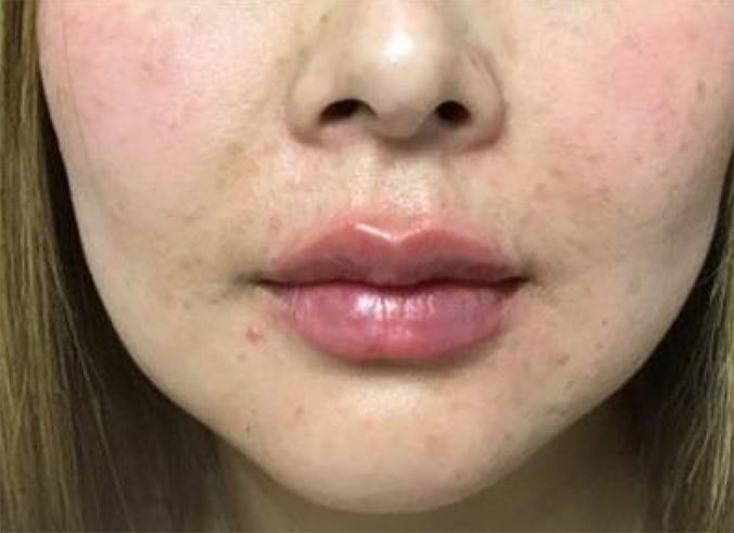 After Restylane Kysse: the same view after treatment, the lips look fuller and glossier