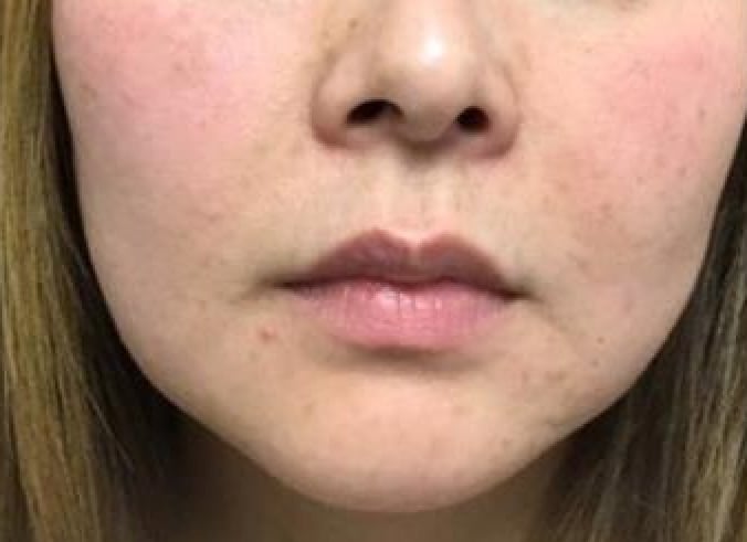 Before Restylane Kysse: front view of a woman’s nose, lips and cheeks, natural lips