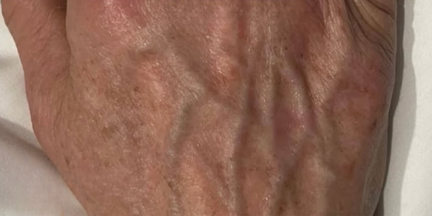 After AFT treatment: the same hand after treatment, the brown spots are lighter