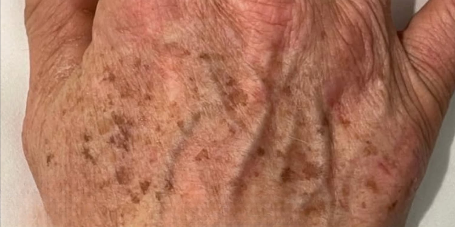 Before AFT treatment: the back of a hand with brown spots and visible veins