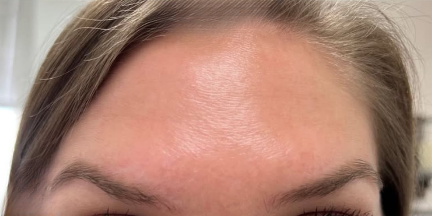 After Botox: the same view after treatment, the forehead is smooth