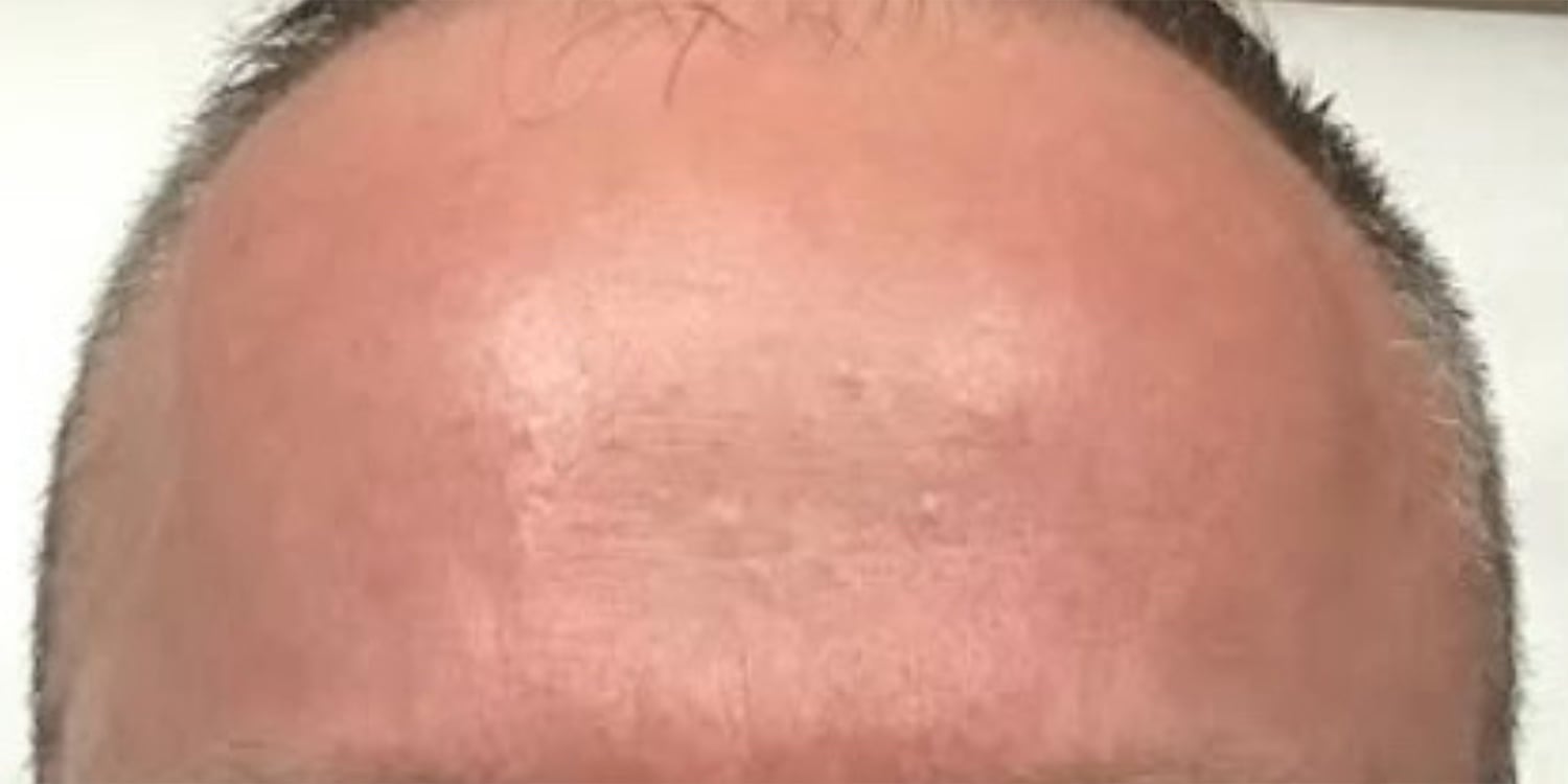 After Botox: the same view after treatment, the forehead is smooth
