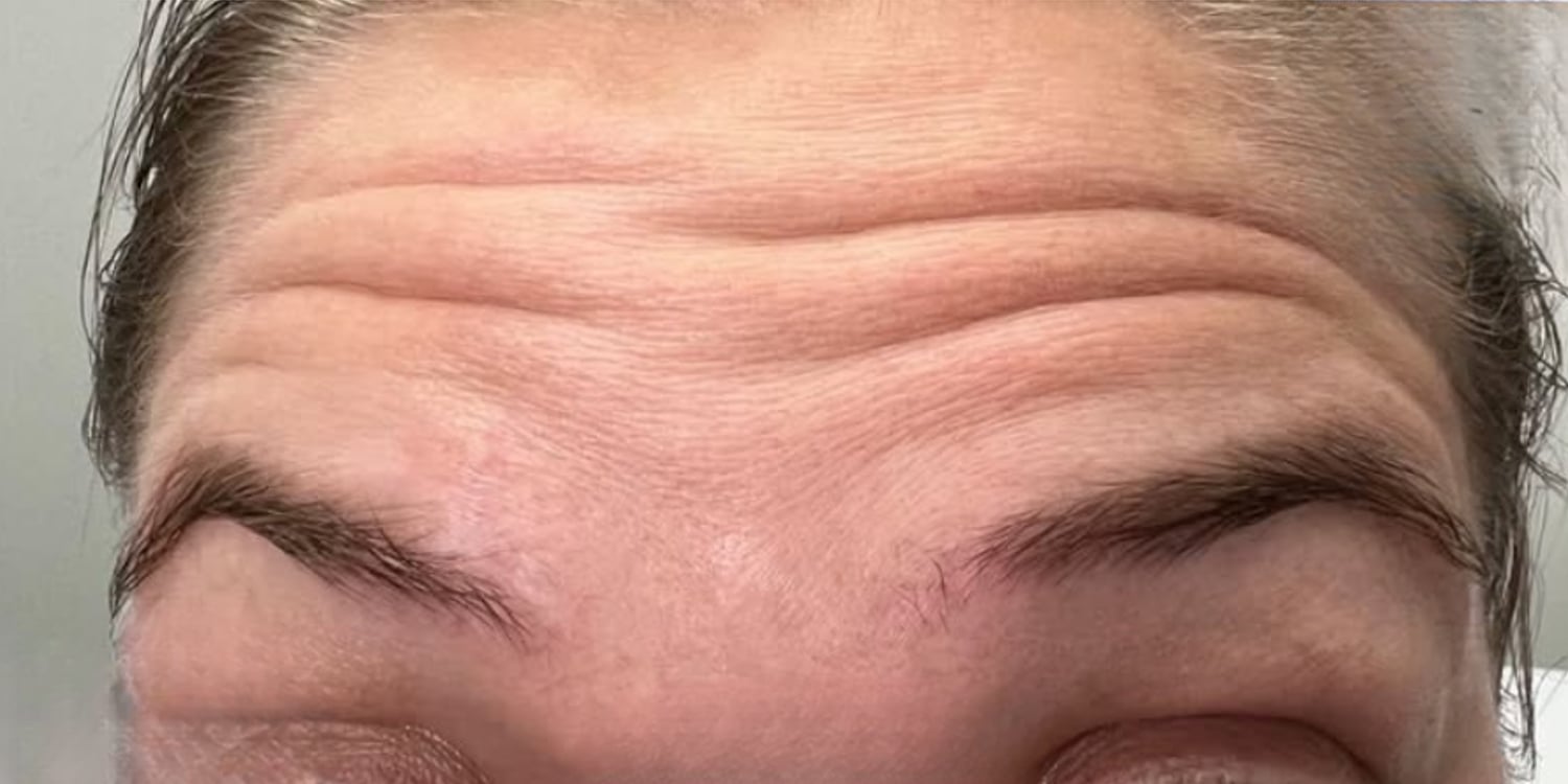Before Botox: front view of a woman’s forehead with deep horizontal lines