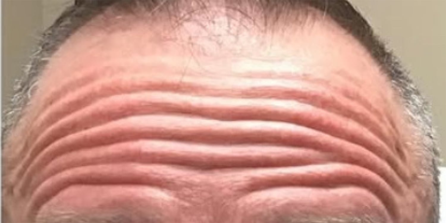 Before Botox: front view of a man’s forehead with deep horizontal lines