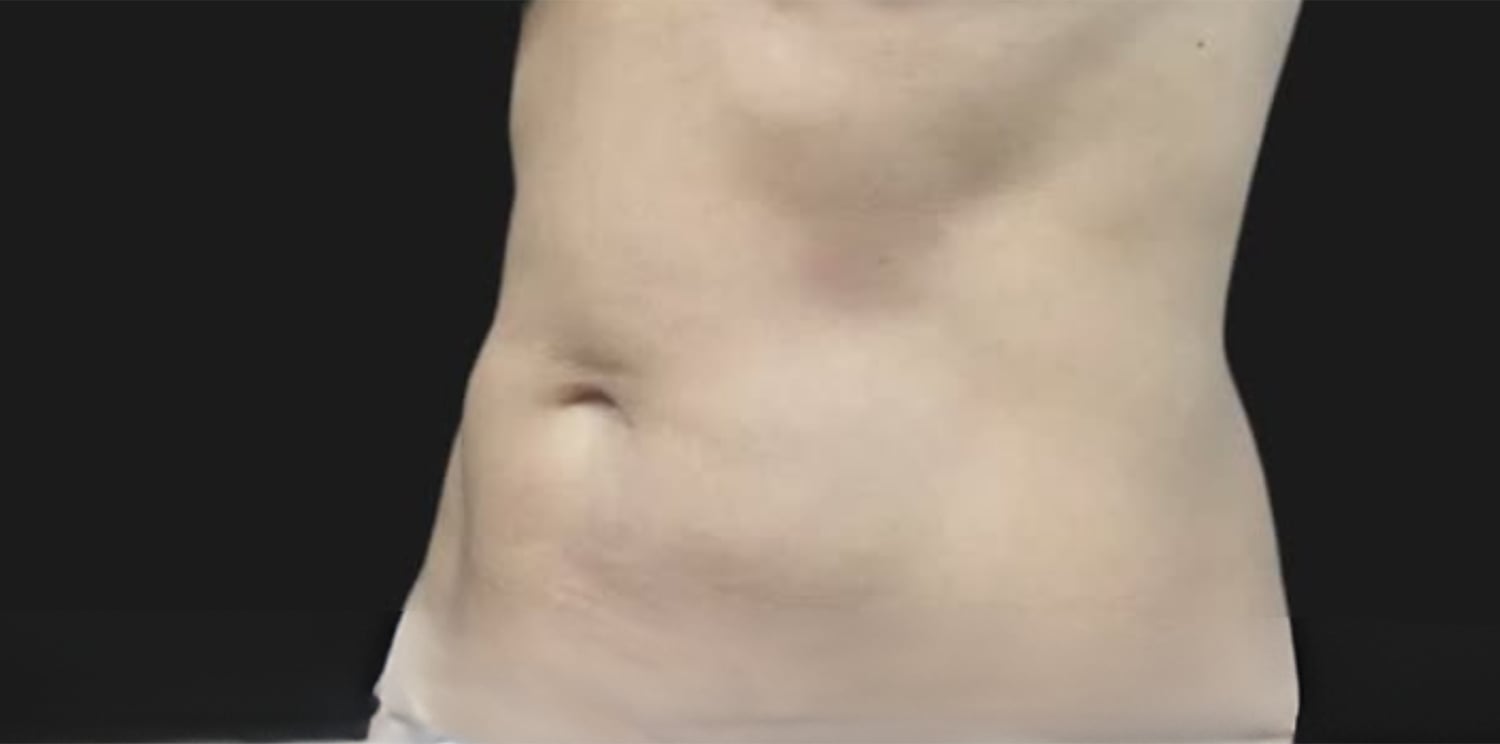 After CoolSculpting: the same view after treatment, the abdomen looks flatter