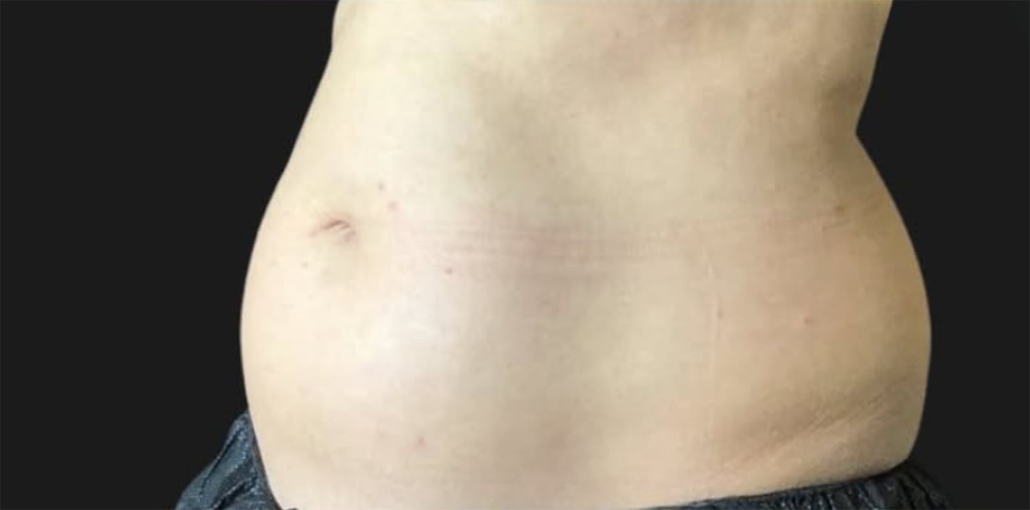 Before CoolSculpting: left side view of a bare abdomen, rounded, in dark shorts