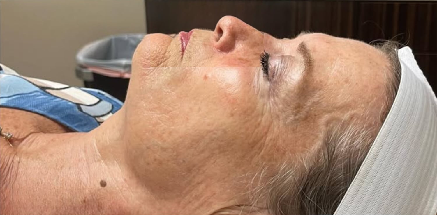 After DiamondGlow: the same view after treatment, her skin looks brighter and smoother