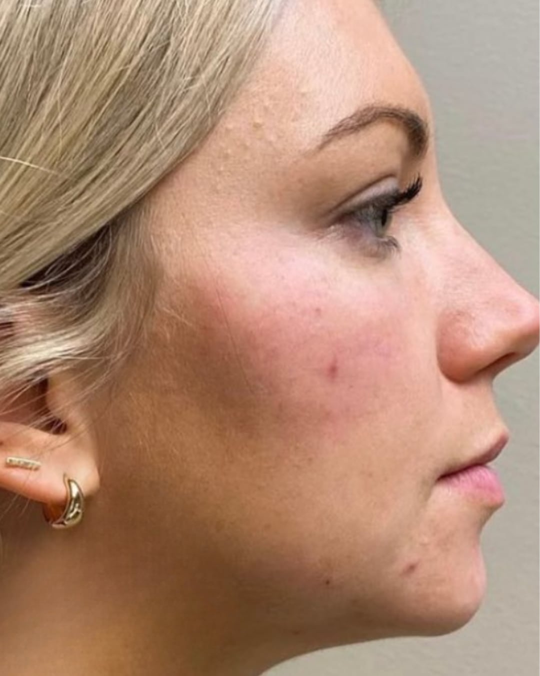After facial rejuvenation: the same view after treatment, the cheek and jawline look slightly fuller