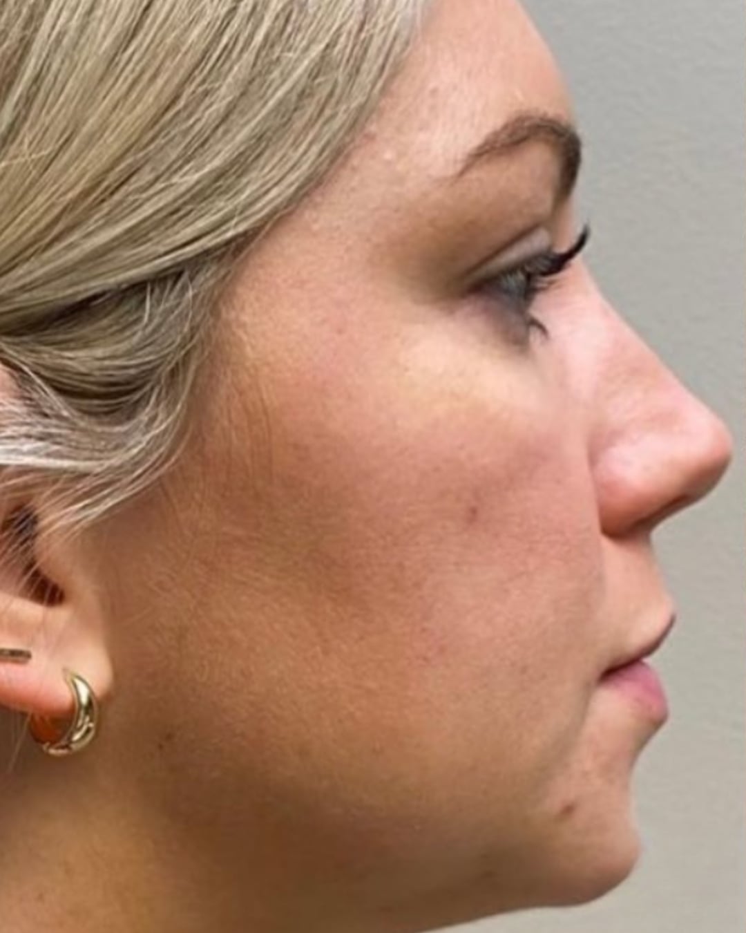 Before facial rejuvenation: a woman in right profile with blond hair, a gold hoop earring and a defined jawline