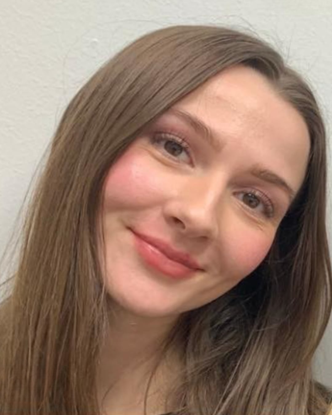 After lip filler: the same woman after treatment, the lips look fuller