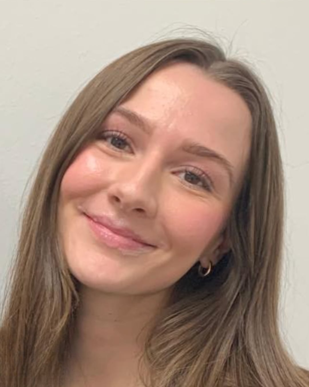 Before lip filler: a smiling woman with long brown hair, head tilted, natural lips