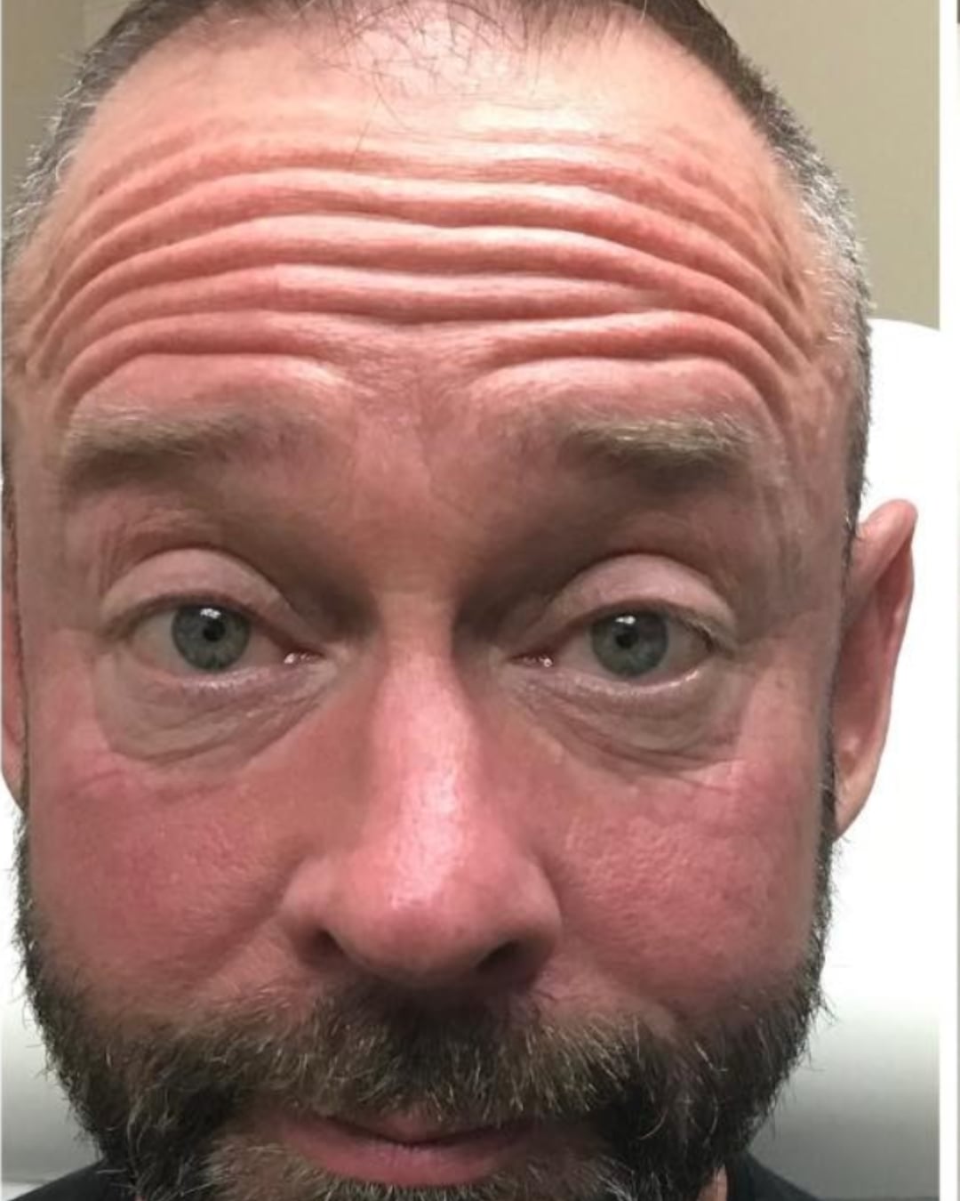 Before Botox: front view of a bearded man with raised brows and deep forehead lines