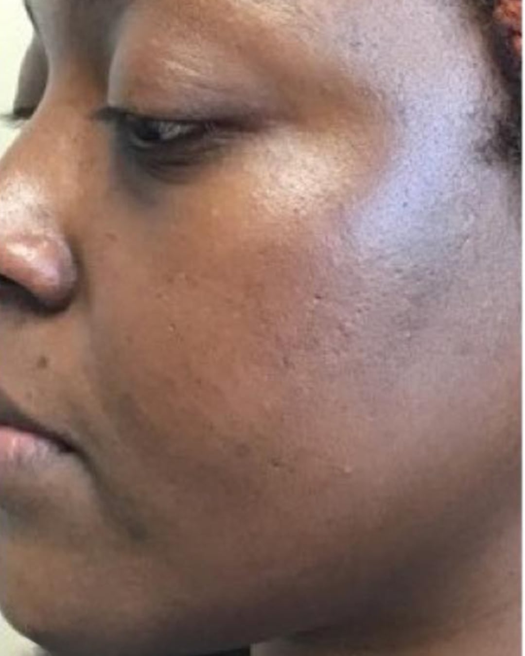 After microneedling: the same view after treatment, the skin tone looks more even