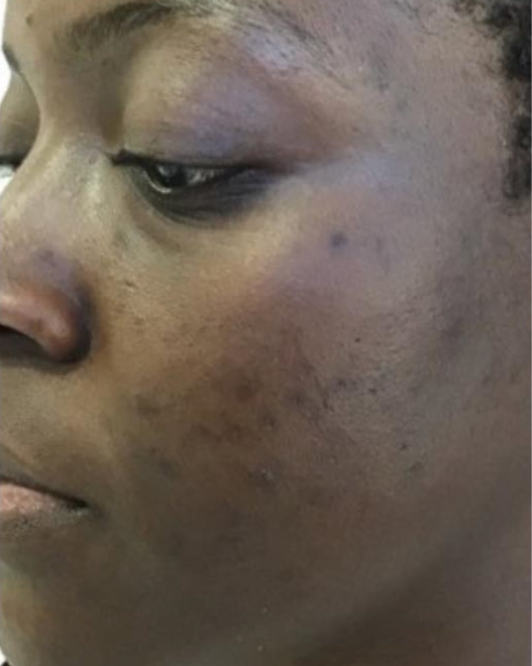 Before microneedling: a woman’s cheek and eye area, left front oblique view, with dark patches on the skin