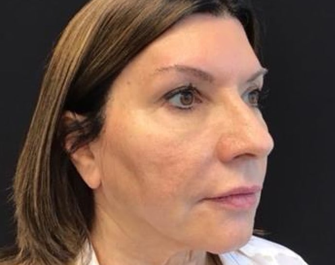 After Sculptra, two sessions: the same woman with her hair down, face turned slightly to the right, against a black backdrop