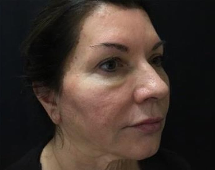Before Sculptra, two sessions: a woman with dark hair pulled back, face turned slightly to the right, against a black backdrop