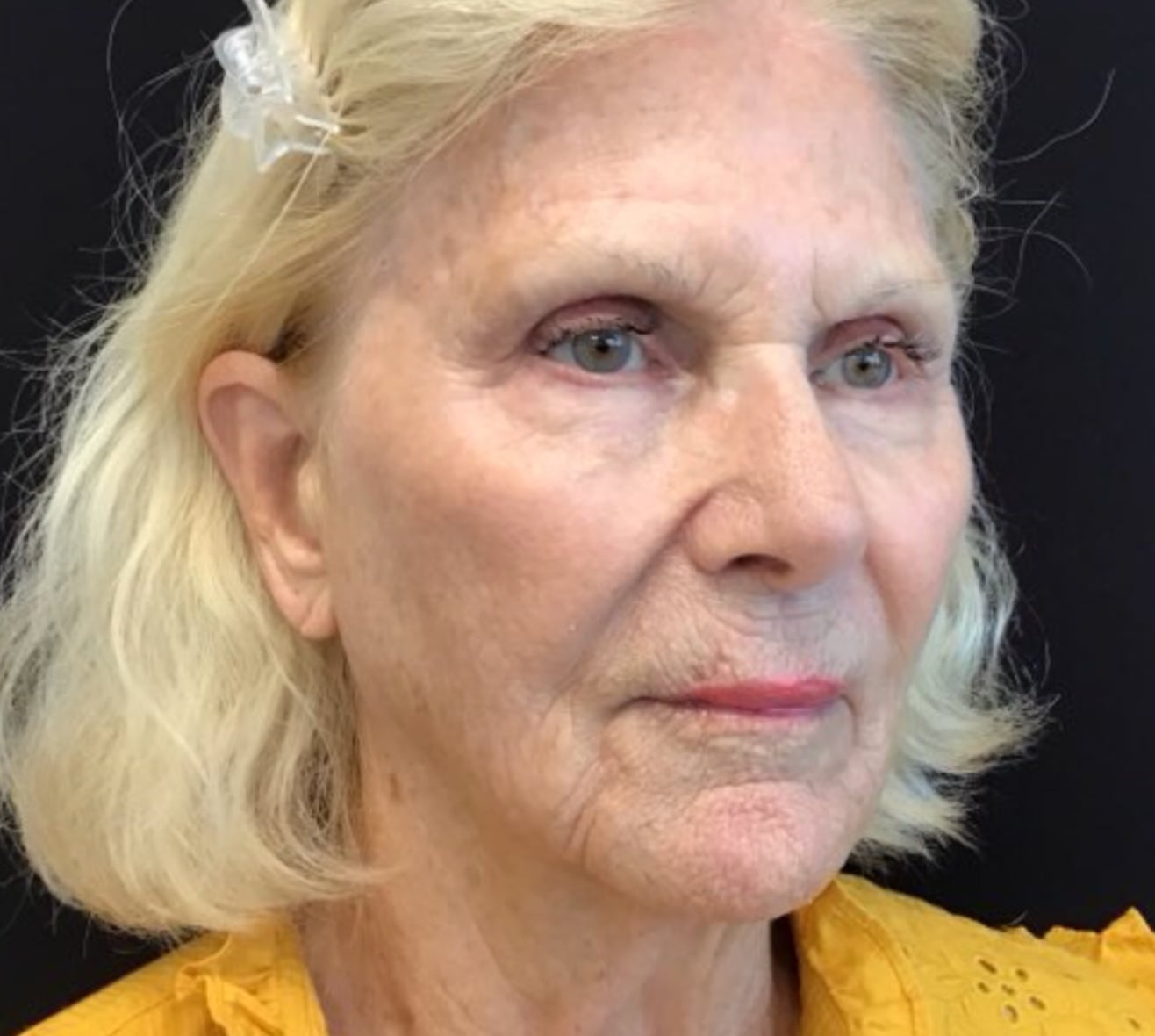 After Sculptra: the same woman with her hair down, face turned to the right, in a yellow top