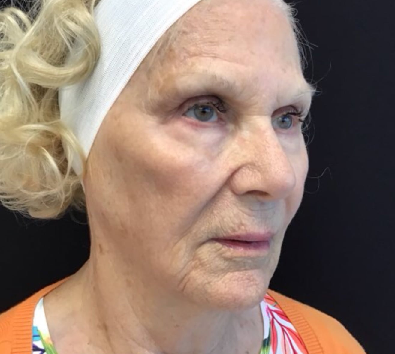 Before Sculptra: a woman with a white headband, face turned to the right, in an orange top