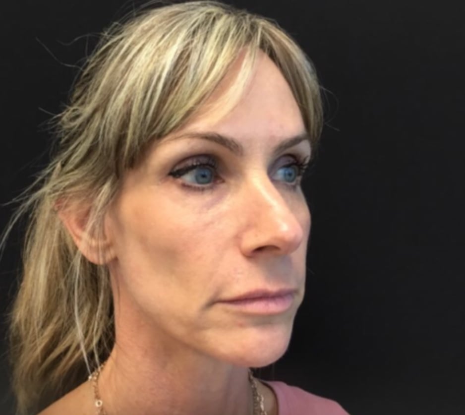 Before Sculptra, one session: a woman with blond hair and bangs, face turned to the right, in a pink top