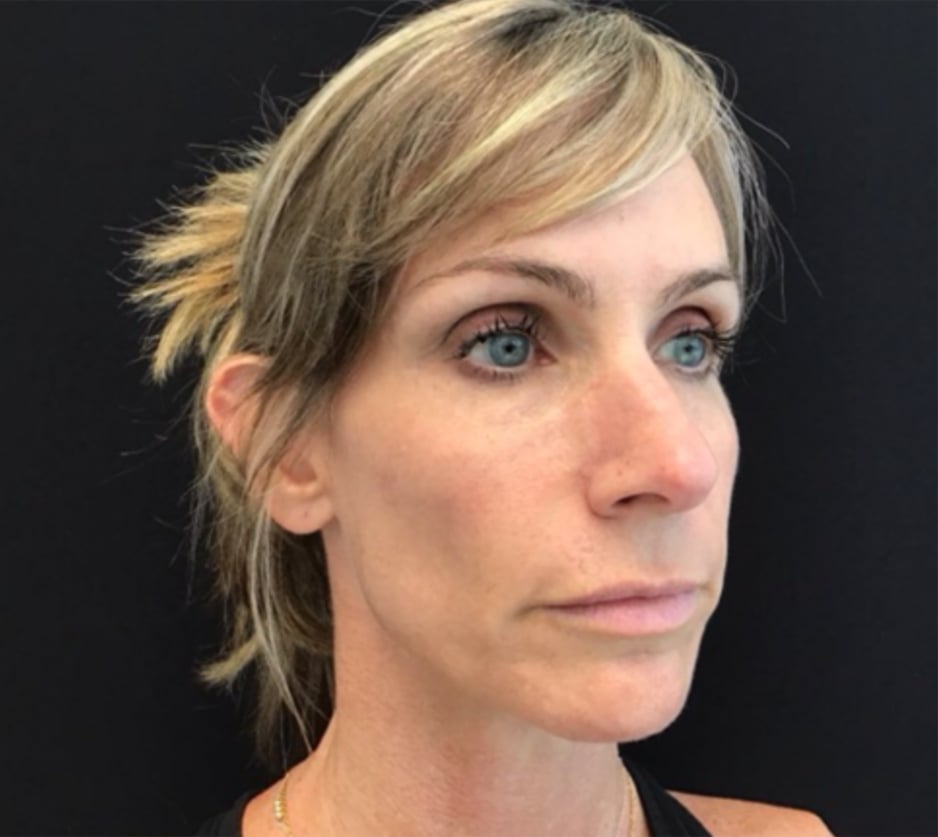 After Sculptra, one session: the same woman with her hair swept back, face turned to the right, in a black top