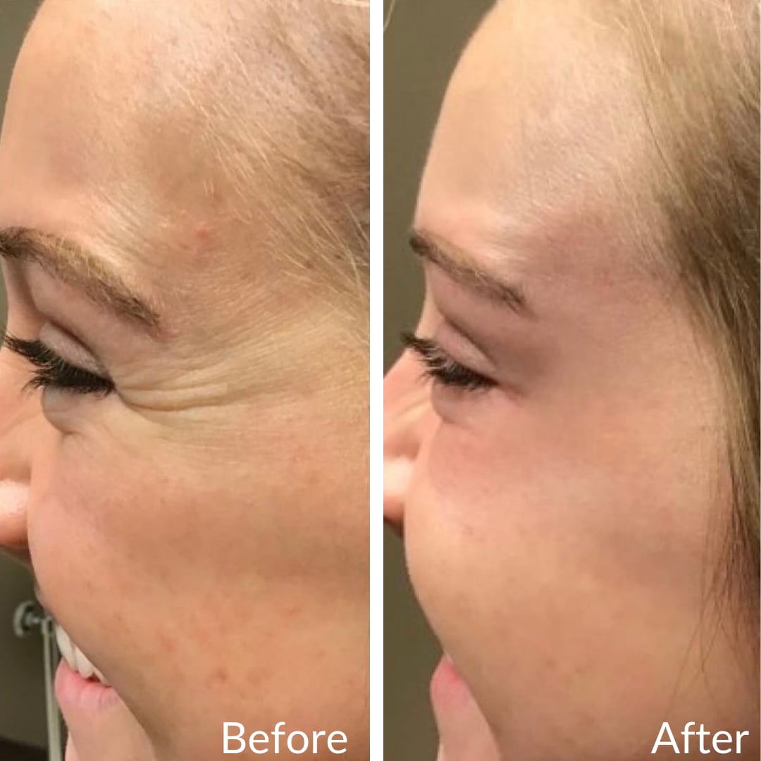 Photograph of a patient’s outer eye area, smiling before (left) and after (right), Botox for crow’s feet, left side view: lines fanning from the corner of the eye before, a smoother corner after