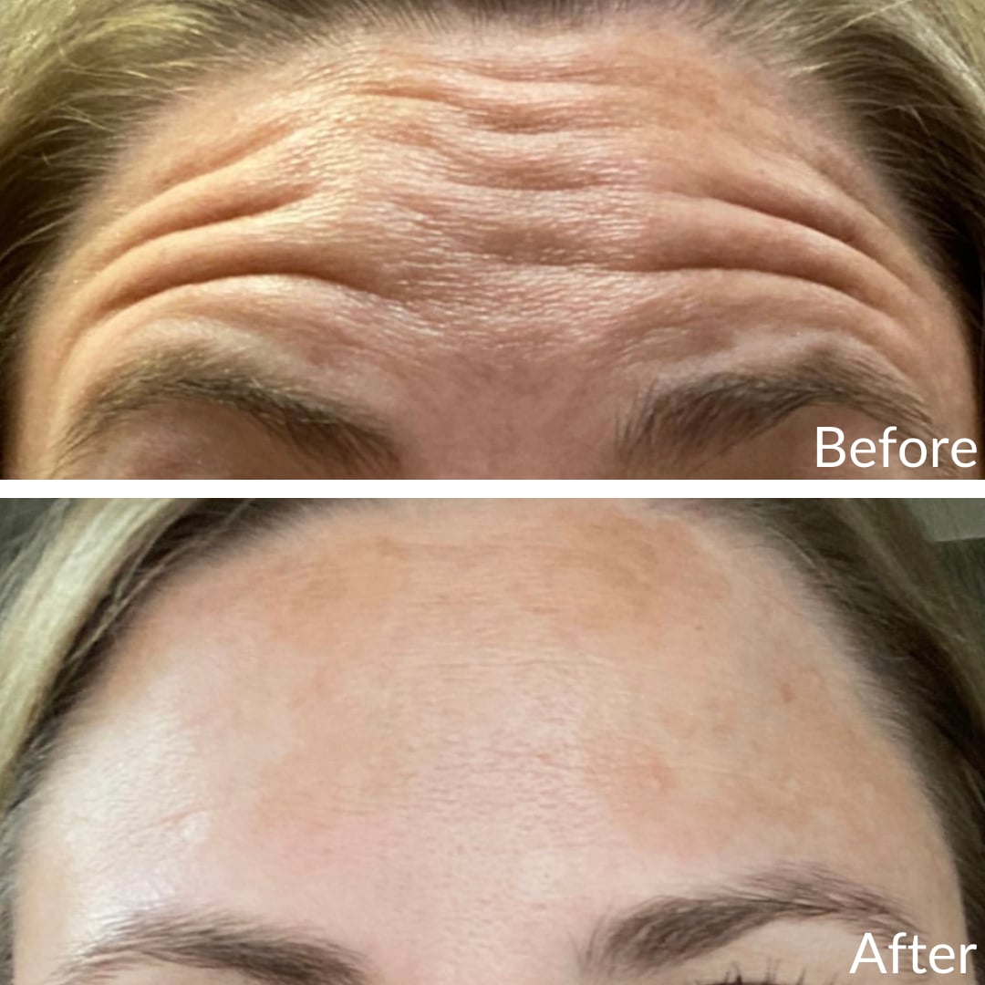 Photograph of a patient’s forehead before (top) and after (bottom), Botox, front view: deep horizontal forehead lines before, a smooth forehead after