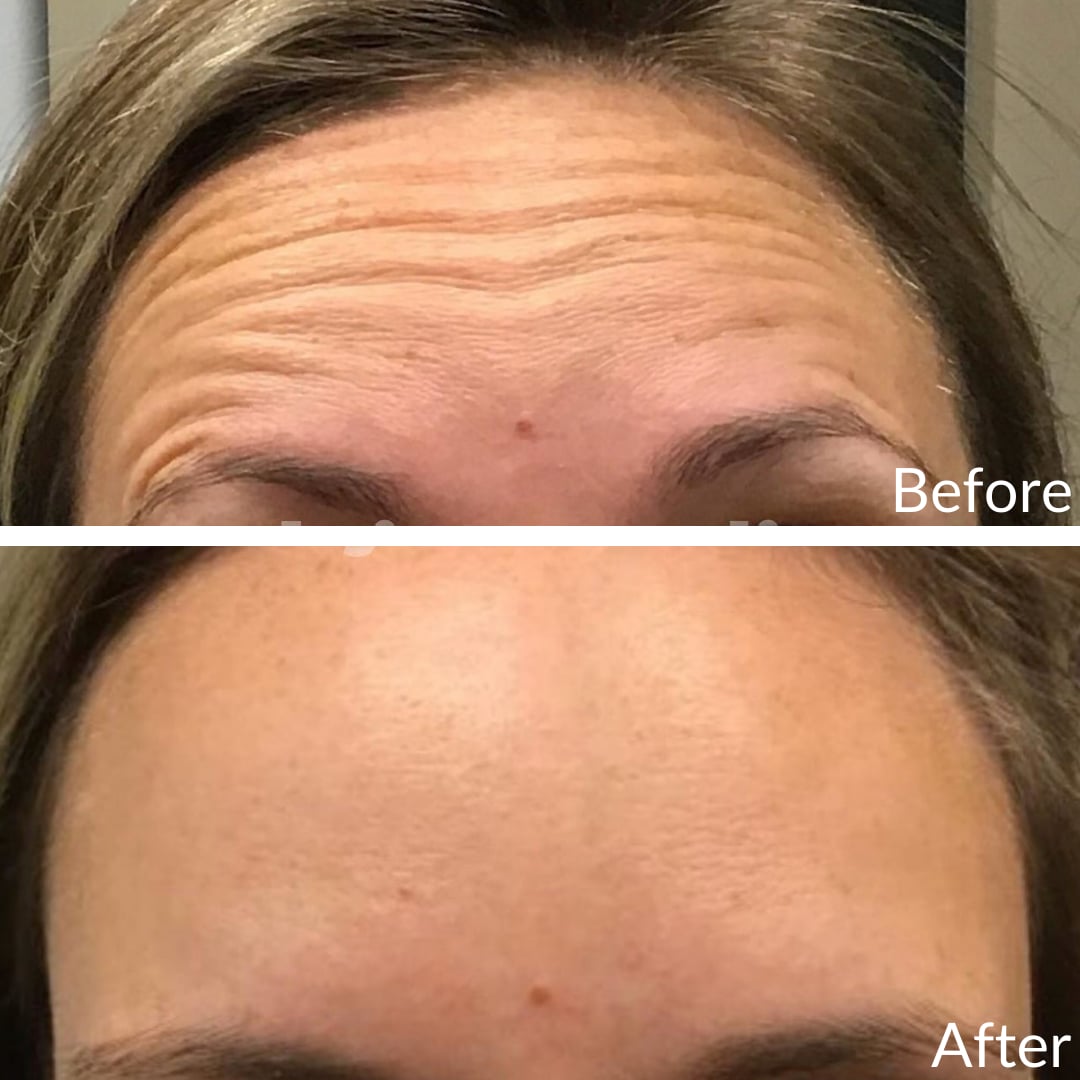 Photograph of a patient’s forehead before (top) and after (bottom), Botox, front view: horizontal forehead lines before, a smooth forehead after