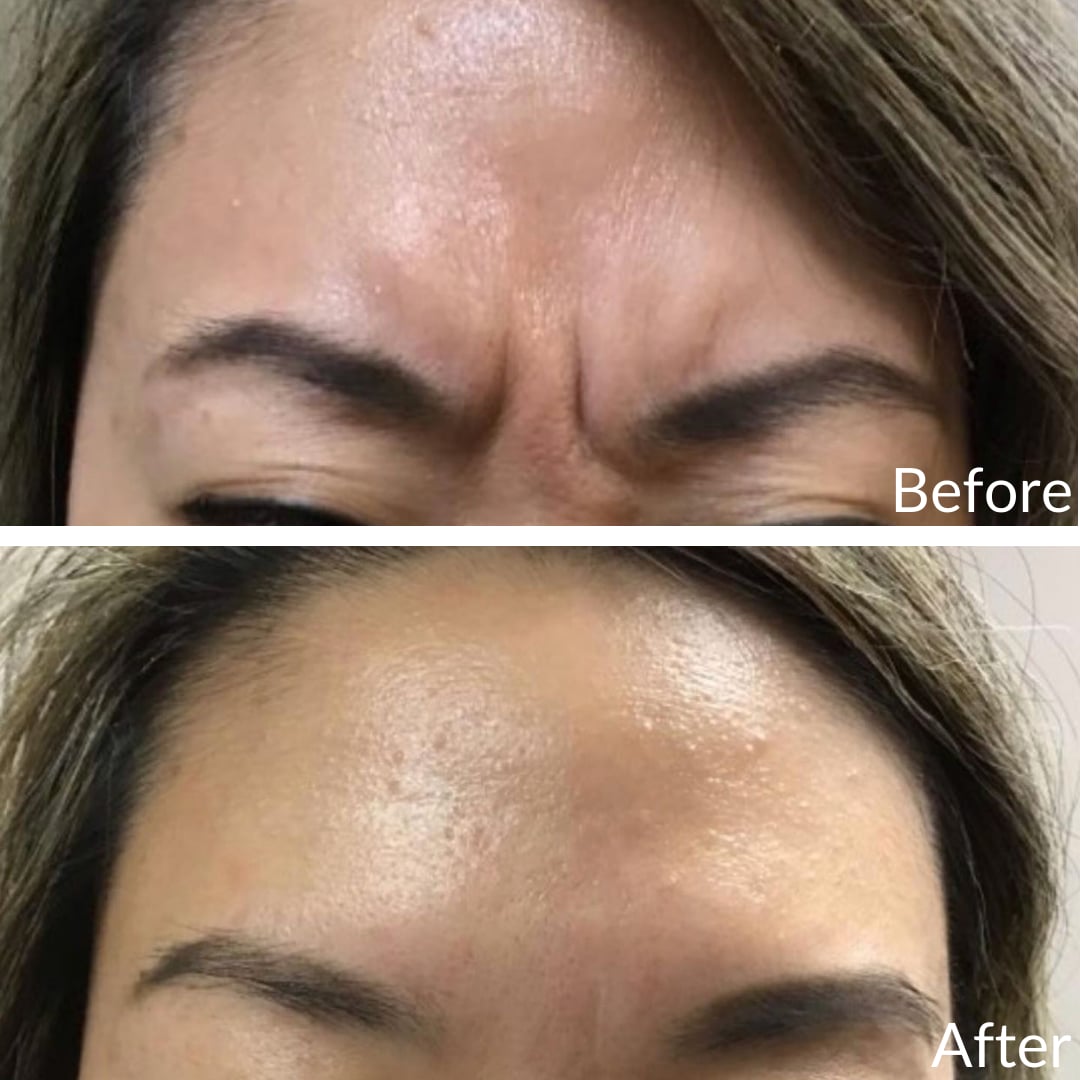 Photograph of a patient’s forehead and brows before (top) and after (bottom), Botox, front view: frown lines between the brows before, a smooth forehead after