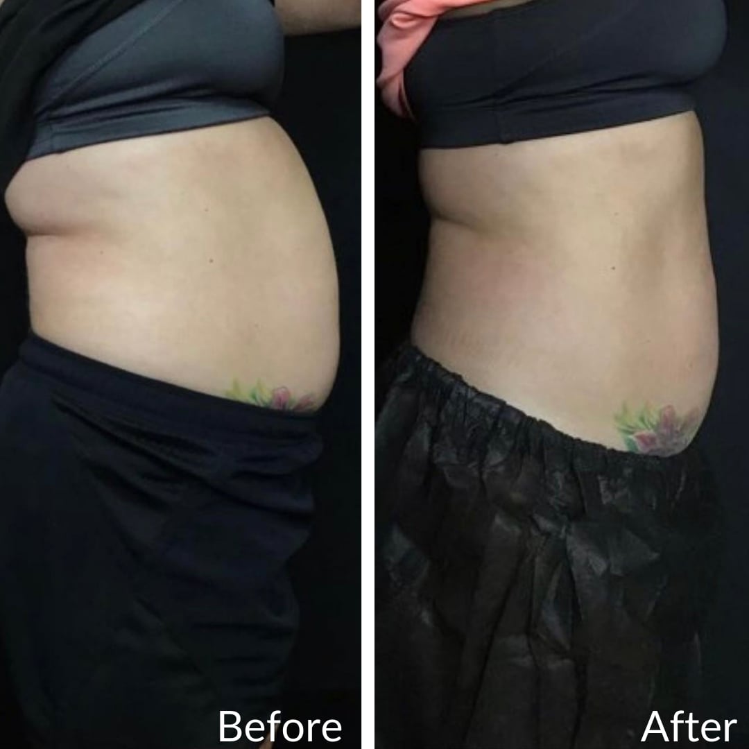 Photograph of a patient’s abdomen in profile before (left) and after (right), CoolSculpting, right side view: a rounder abdomen before, a flatter abdomen after