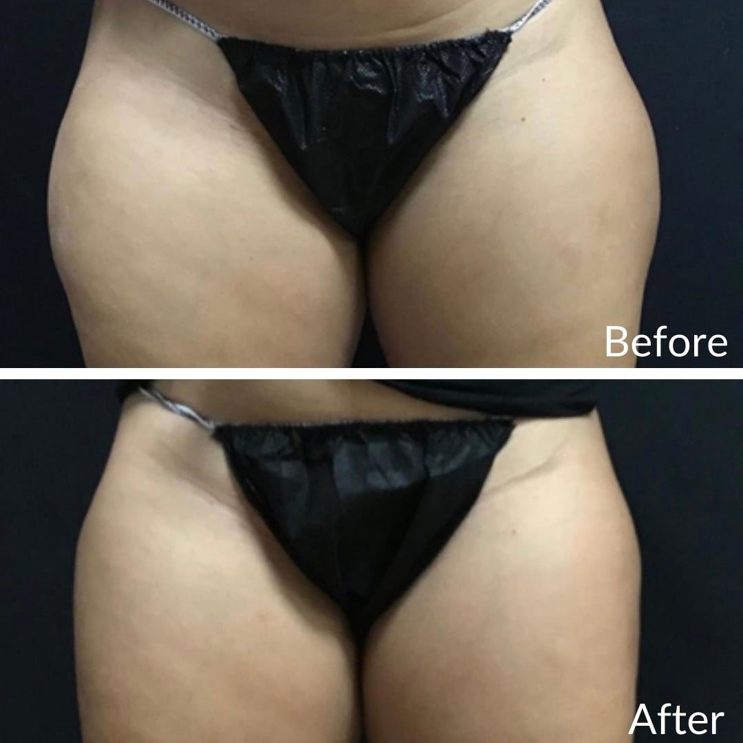 Photograph of a patient’s hips and upper thighs before (top) and after (bottom), CoolSculpting, front view: fuller outer thighs before, a smoother contour after