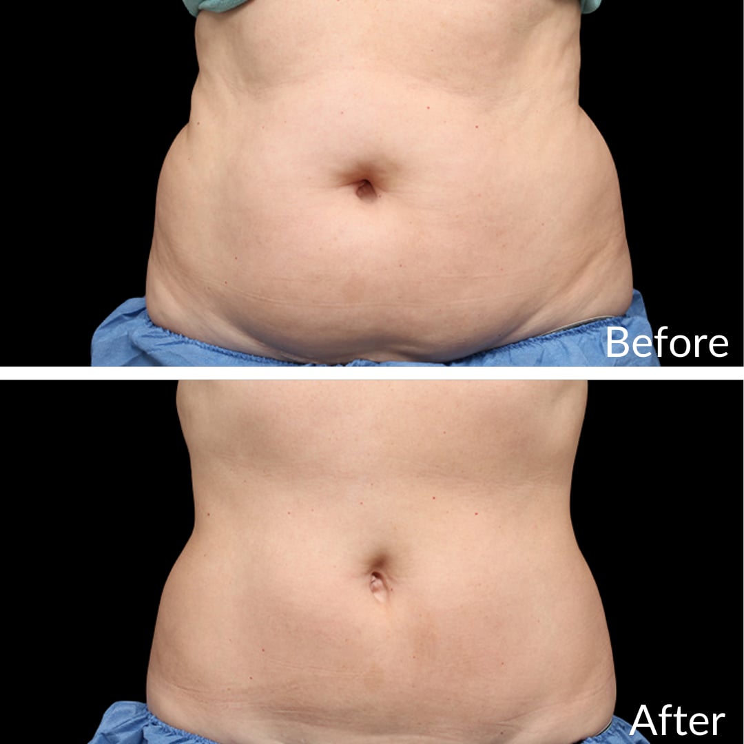Photograph of a patient’s abdomen before (top) and after (bottom), CoolSculpting, front view: a rounder midsection before, a flatter midsection after