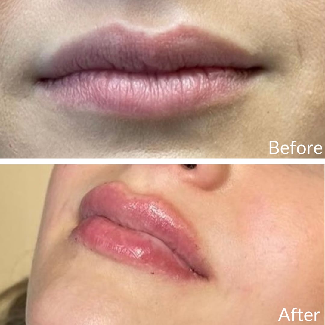 Photograph of a patient’s lips seen from below before (top) and after (bottom), lip filler, angled view: a flatter lip before, a fuller and glossier lip after