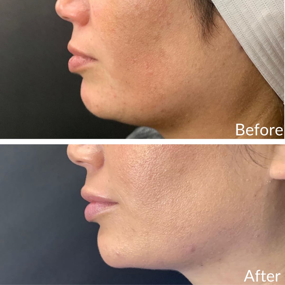 Photograph of a patient’s lower face in left profile before (top) and after (bottom), lip filler, left side view: the lips sit flatter before and project more after