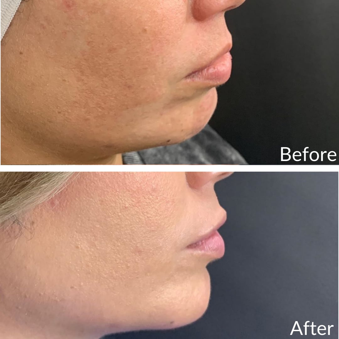 Photograph of a patient’s lower face in right profile before (top) and after (bottom), lip filler, right side view: the lips sit flatter before and project more after