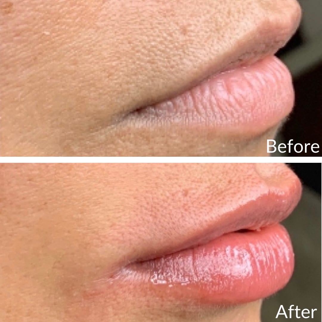 Photograph of a patient’s lips in profile before (top) and after (bottom), lip filler, right side view: a narrow lip before, a fuller and glossier lip after