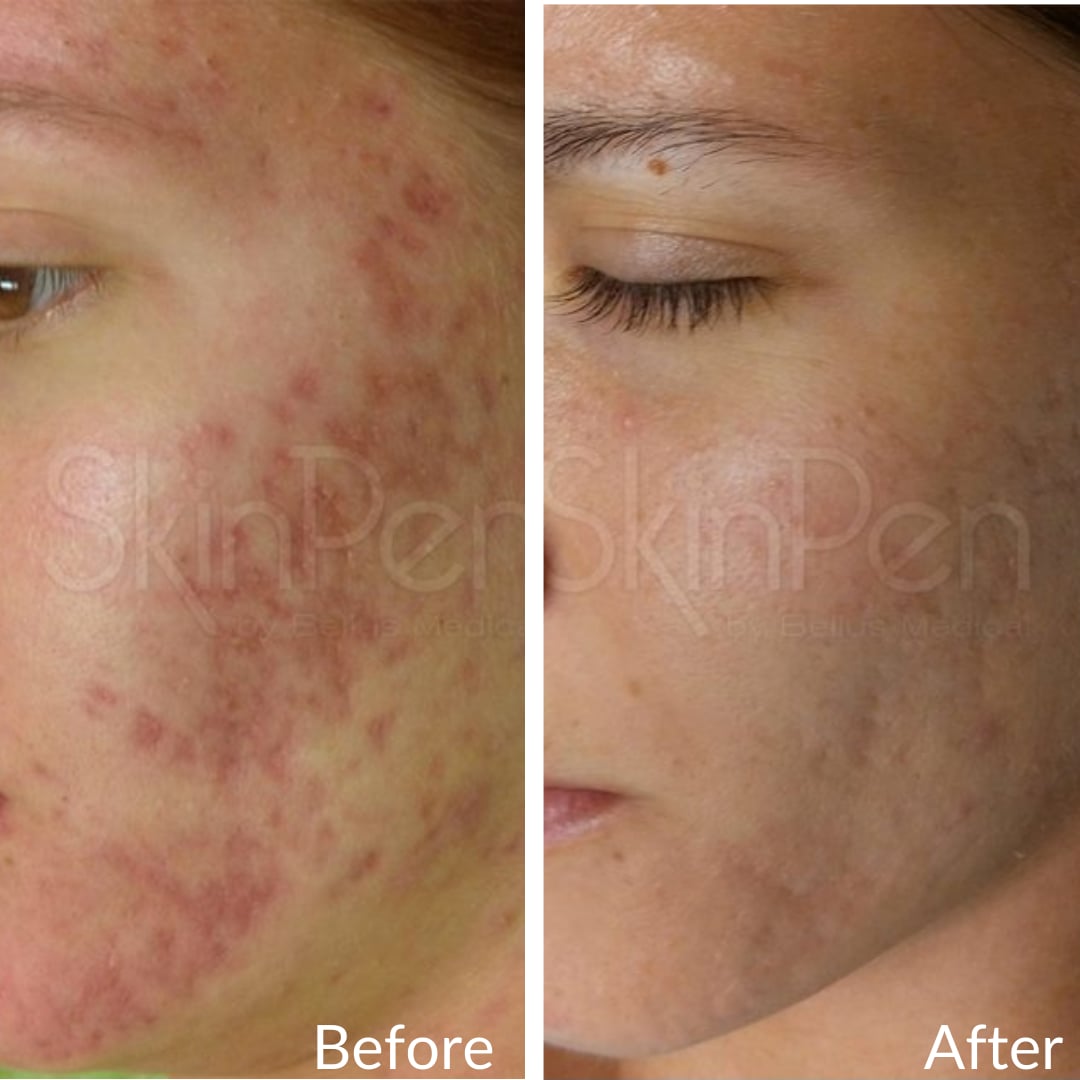 Photograph of a patient’s cheek before (left) and after (right), microneedling, left front oblique view: red, blotchy skin before, clearer-looking skin after
