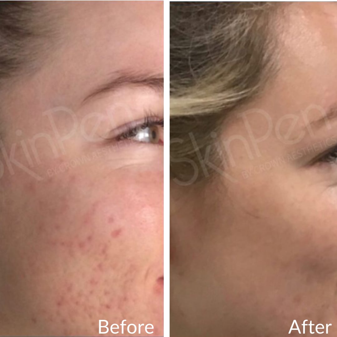 Photograph of a patient’s cheek and eye area before (left) and after (right), microneedling, right side view: red blemishes before, clearer-looking skin after