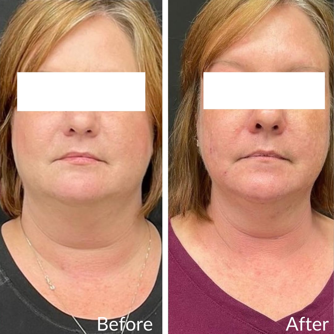 Photograph of a patient’s face and neck, the eyes covered by white boxes before (left) and after (right), CoolSculpting under the chin, front view: fullness under the chin before, a more defined jawline after